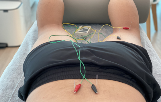 Dry Needling & Neuromodulation - Physio Soins