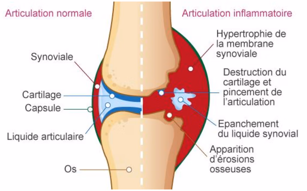 PhysioSoins - Inflammation - Comparaison entre une articulation normale et une articulation inflammatoire (type arthrite) Progression en physiothérapie : comprendre le rôle de l’inflammation et de la nutrition