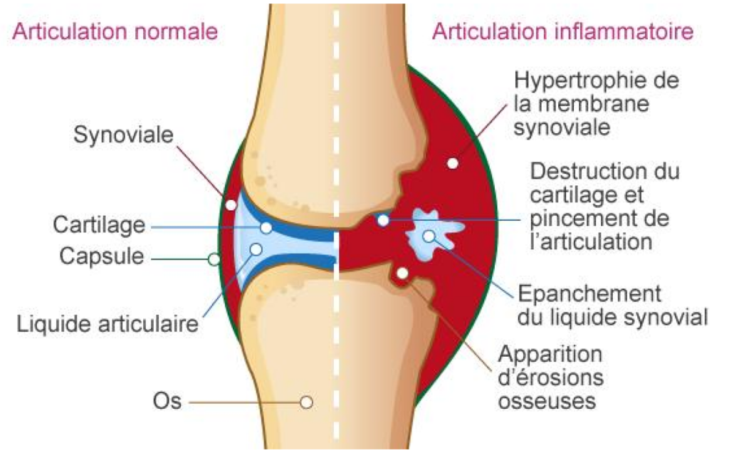 PhysioSoins - Inflammation - Comparaison entre une articulation normale et une articulation inflammatoire (type arthrite) Progression en physiothérapie : comprendre le rôle de l’inflammation et de la nutrition