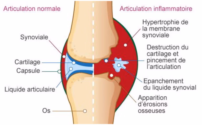 PhysioSoins - Inflammation - Comparaison entre une articulation normale et une articulation inflammatoire (type arthrite) Progression en physiothérapie : comprendre le rôle de l’inflammation et de la nutrition
